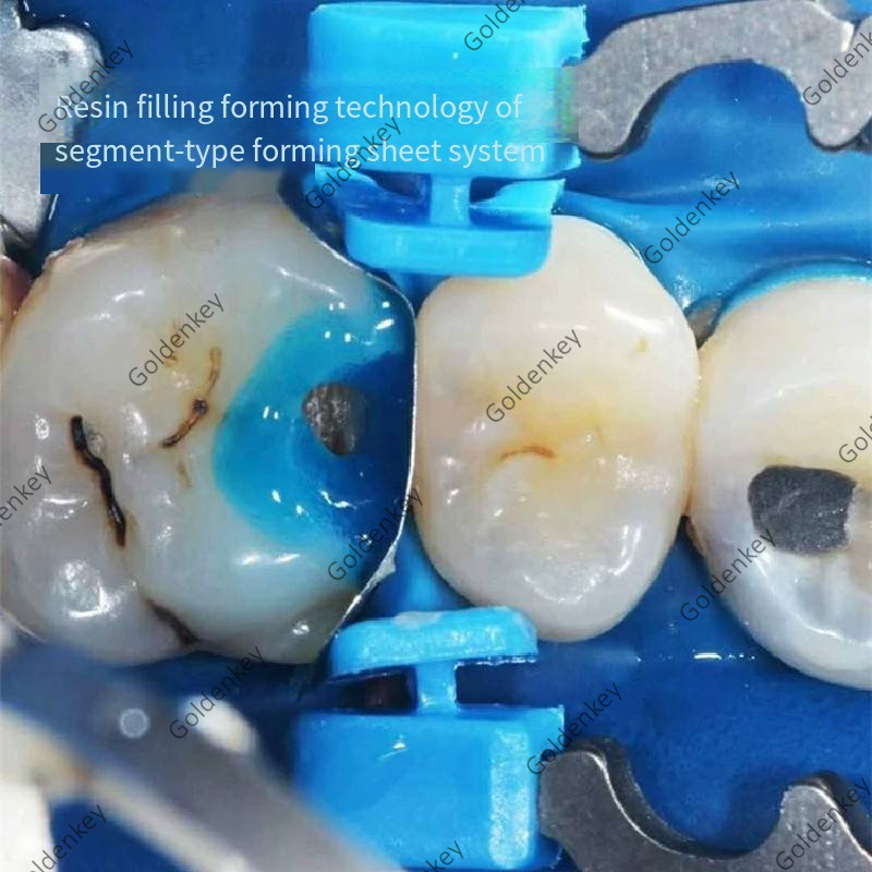 Dental Titanium Alloy Ring Matrix System Clamp Garrison Small And Medium