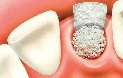 B-OSTIN Sustituto de injerto óseo biocompatible sintético 0,5 CC
