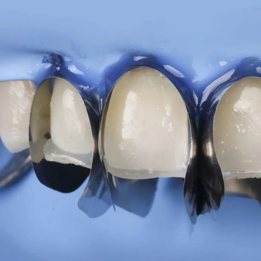 Voco Structur 3 QM Self Cure Composite Material for Crowns & Bridges (Free Ship)