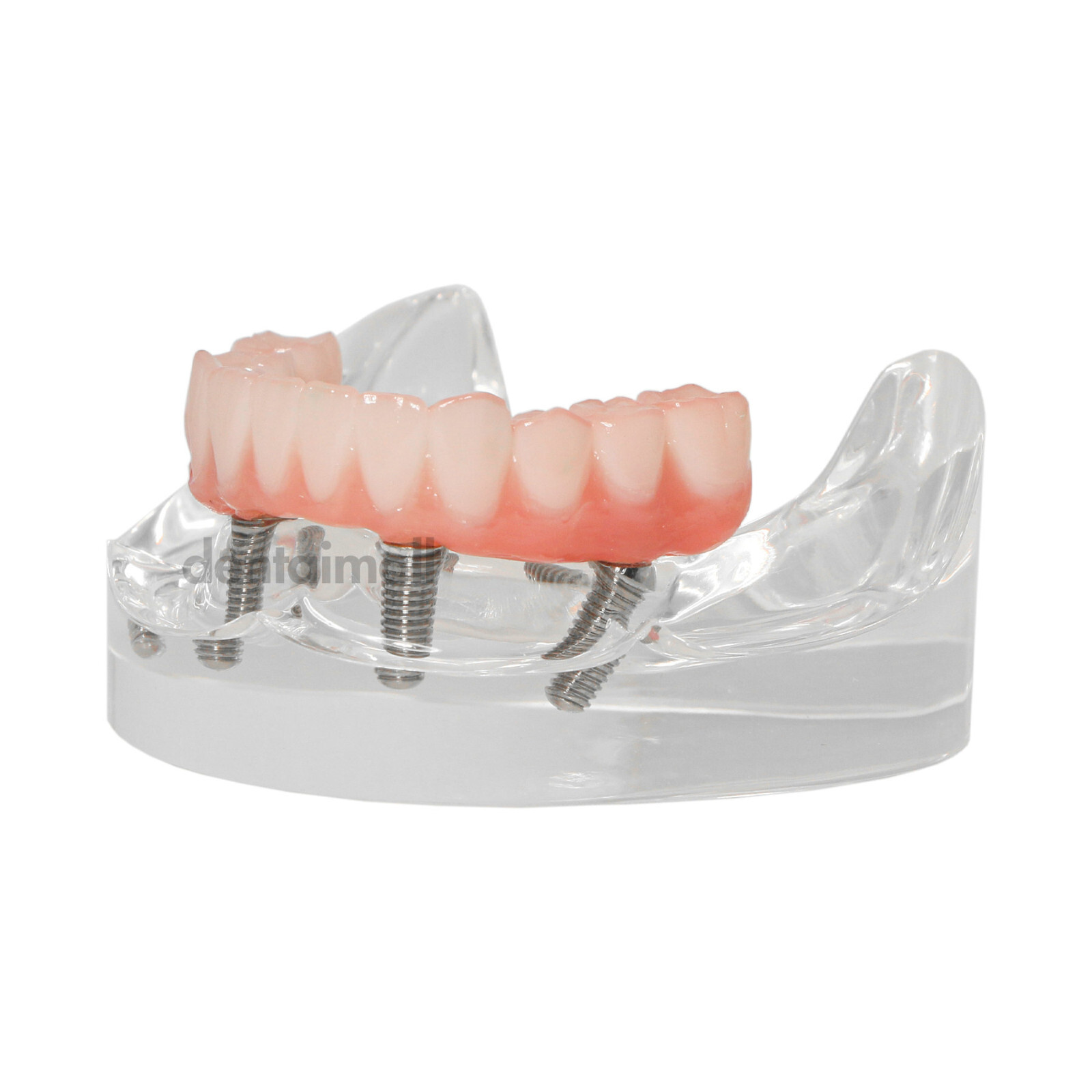 US Dental Overdenture Implant Model All-on-4 With 4 Screw Upper/Lower Clear Jaw