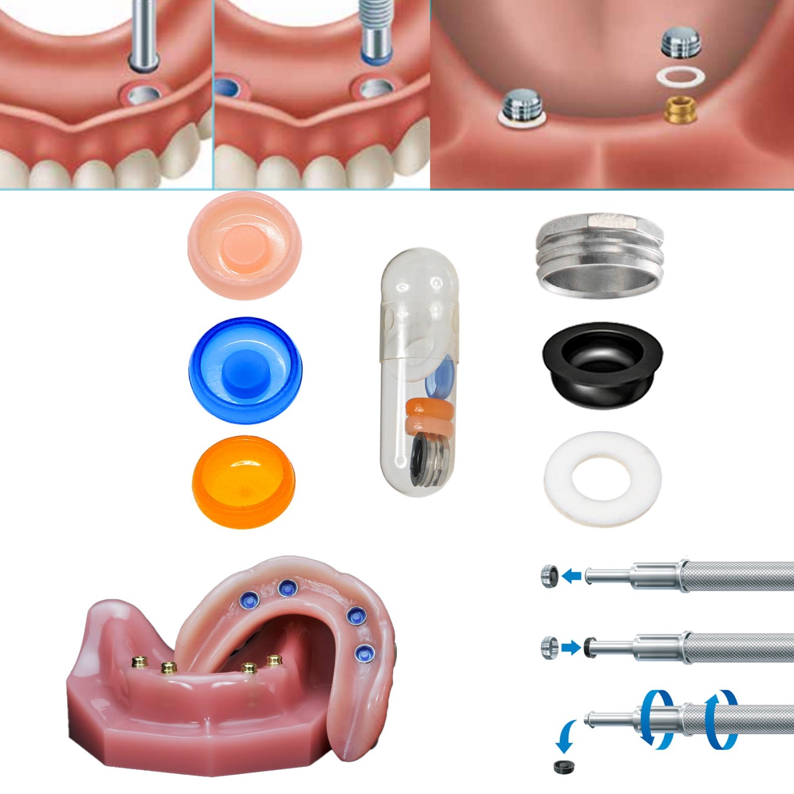Universal Locator Overdenture Caps Insertion Kit 3-in-1 Tool Retentions Lab Caps