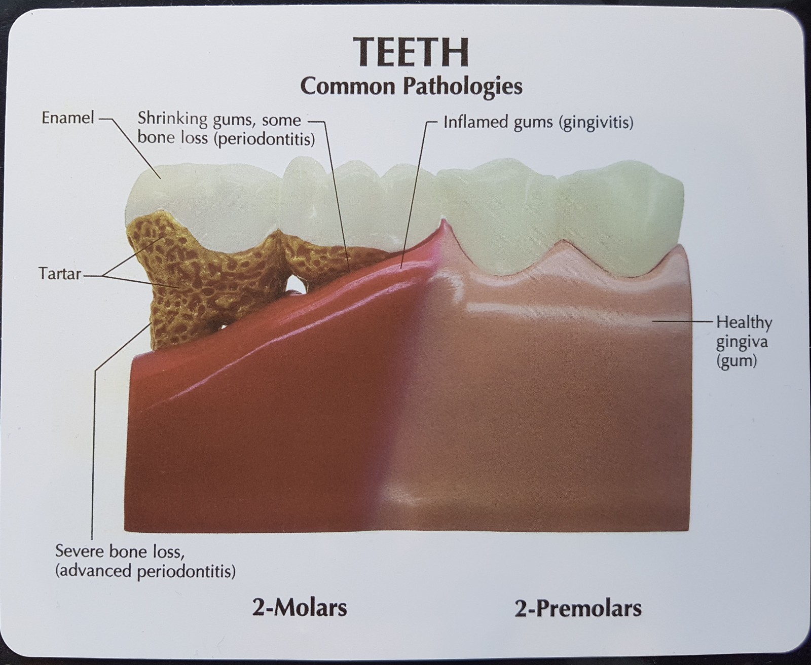 Anatomical Diseased Teeth and Gums Model – Dental Hygiene Medical Tooth Anatomy