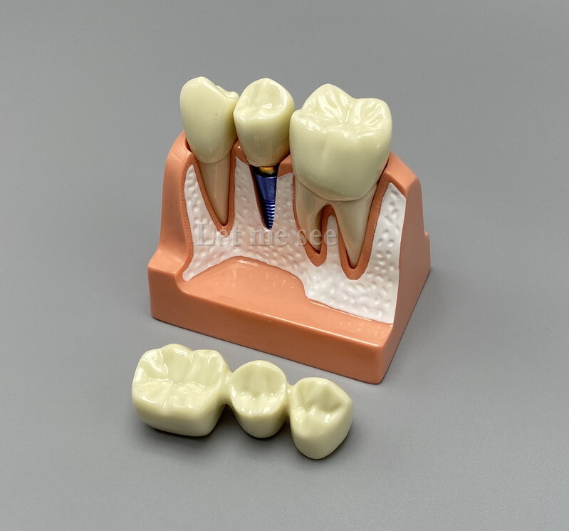 Dental Teaching Model Removable Communication Models Crown Bridge 4 Times Impant