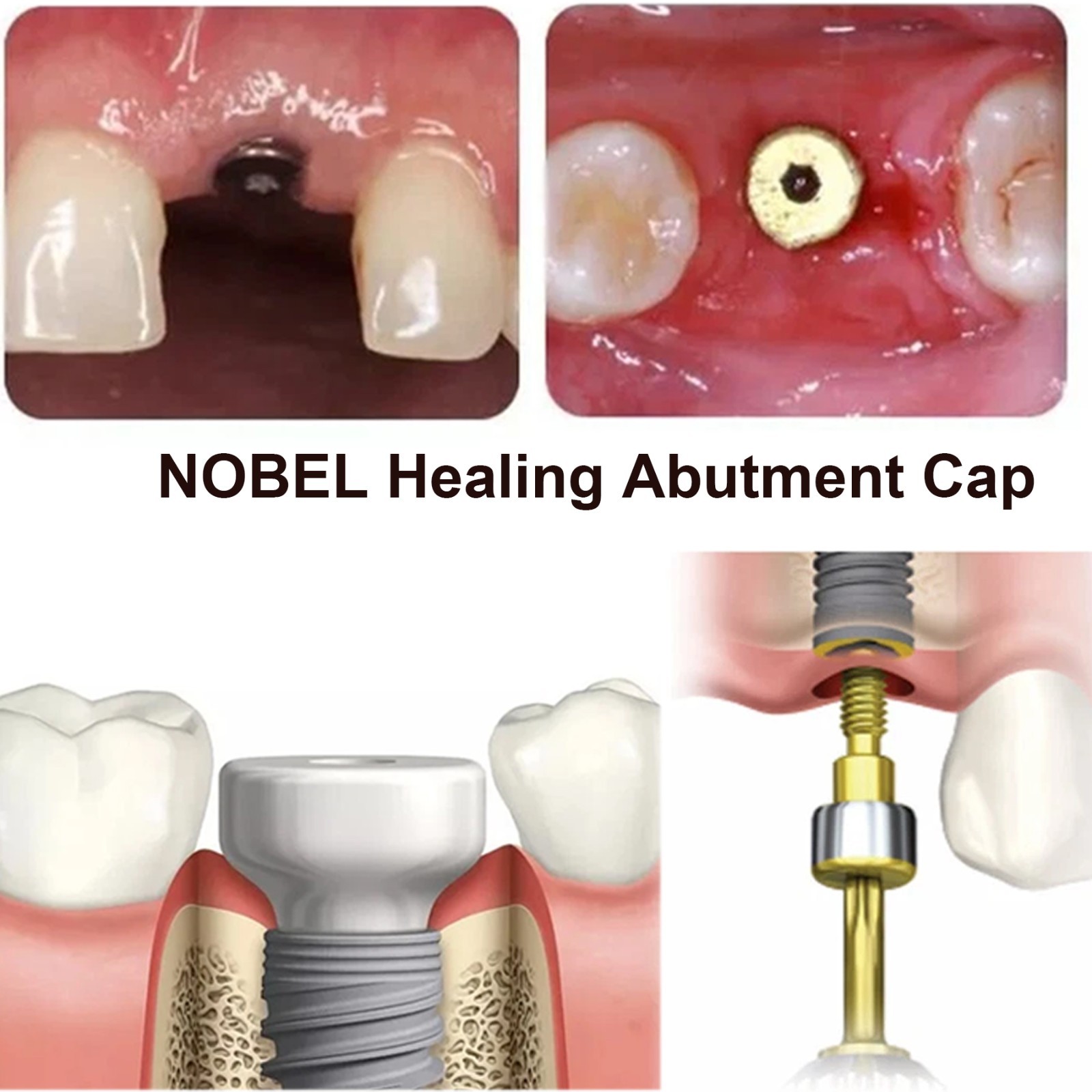 5Pcs Nobel active Healing Abutment Cover Screw Healing Screw Gum Molding Implant
