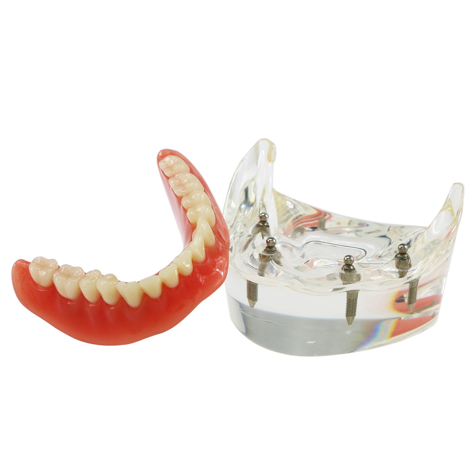 Dental Teeth Model Upper Lower Tooth 4 Implants Restoration Overdenture Model