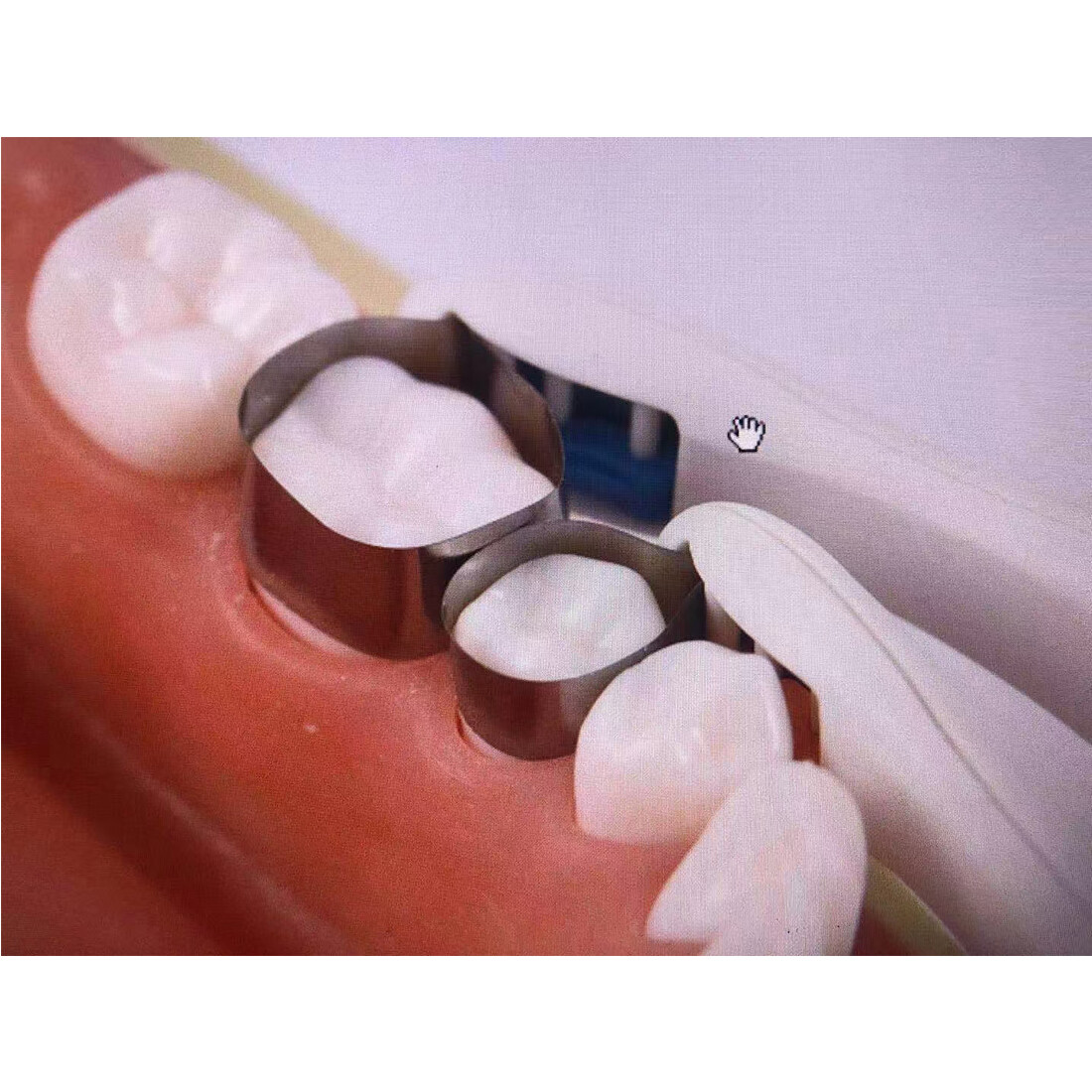 Dental Disposable Pro Matrix System Pre Formed Matrix Bands 50pcs 4.5/6.0mm