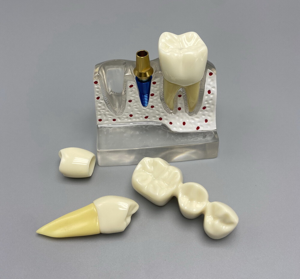 Dental Teaching Model Removable Communication Models Crown Bridge 4 Times Impant