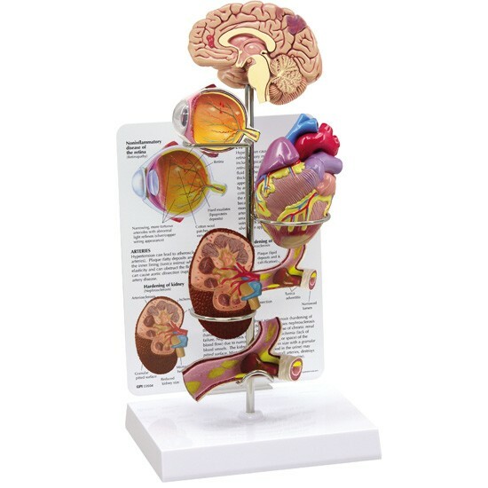 Hypertension 4-pc Organ Set GPI AnatomyModel LFA#4000 Make Us an OfferSEE VIDEO