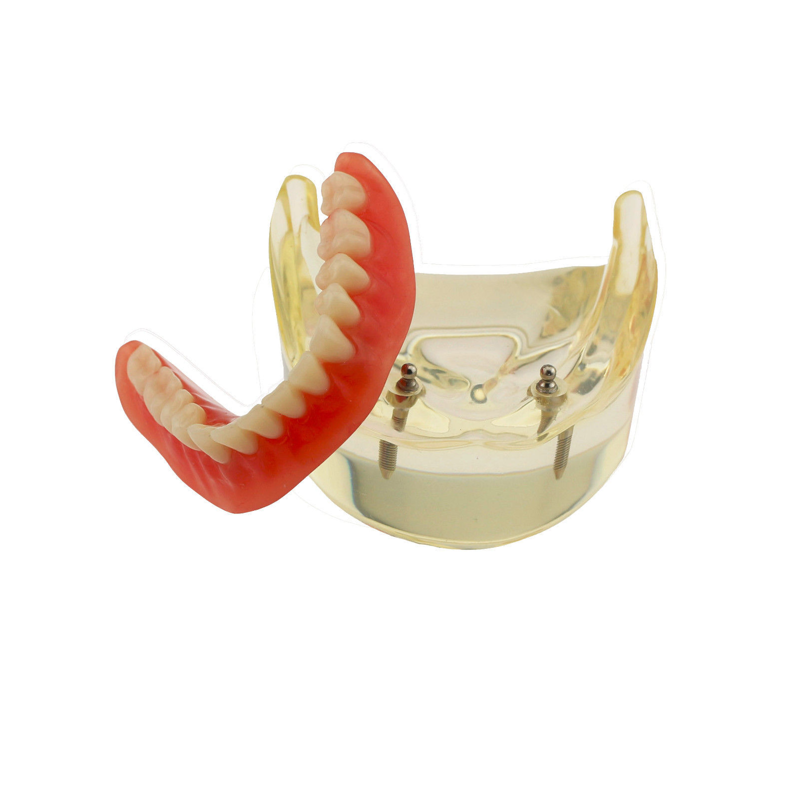Dental Implants Restoration Model Overdenture Inferior With Demo Teaching Study