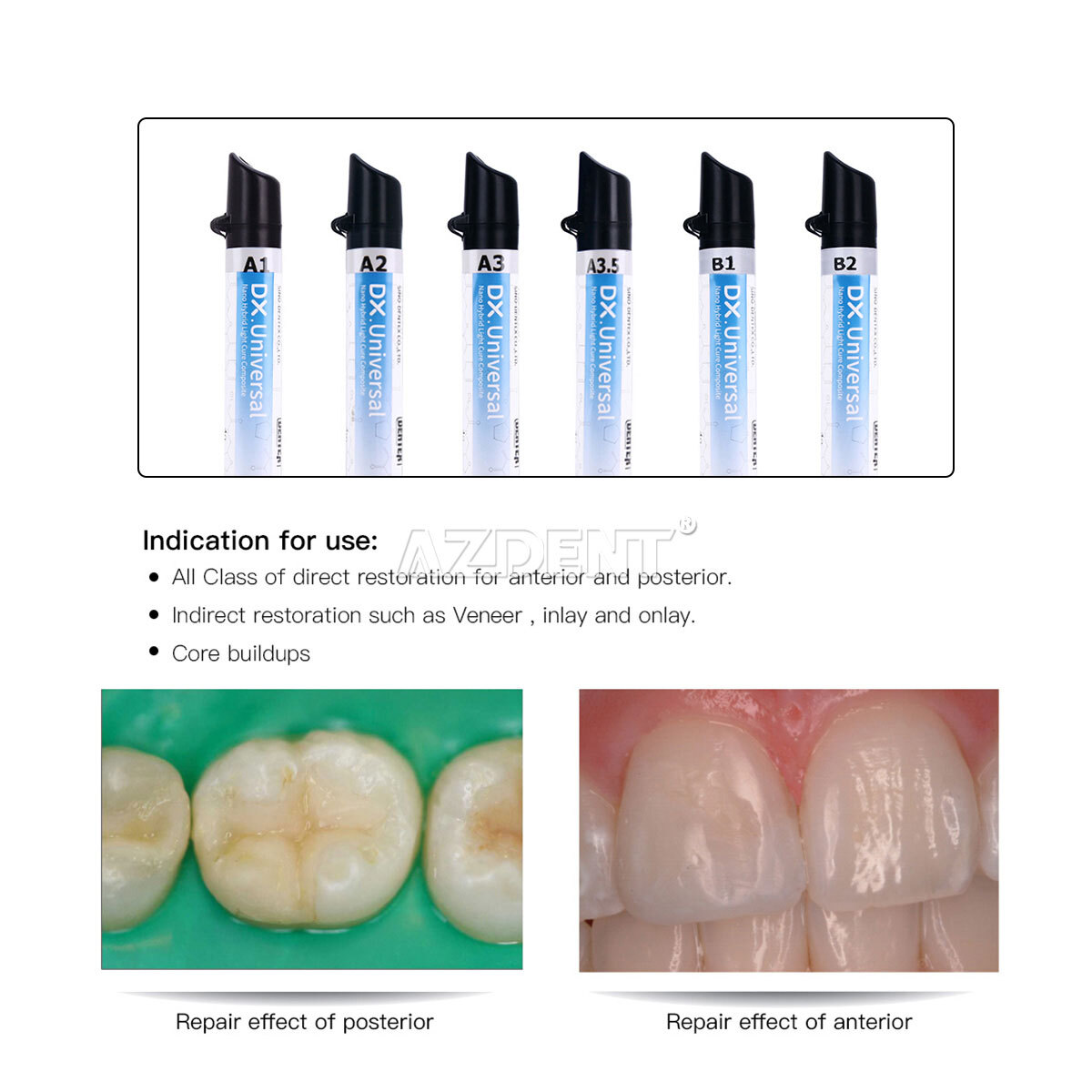 Dentex Dental Universal Light Cure Composite Resin 4g/Syringe A1 A2 A3 A3.5 B1