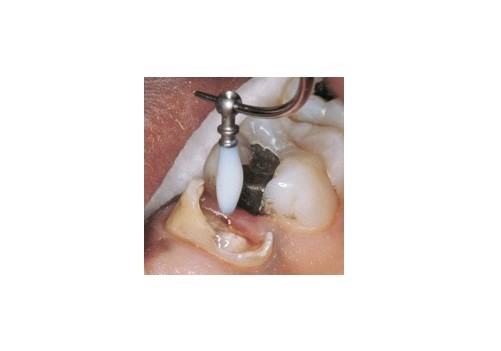 PREMIER DENTAL INTEGRAPOST REFILL SIZE 3,4,4.5,5,6 10PCS/Pk USA