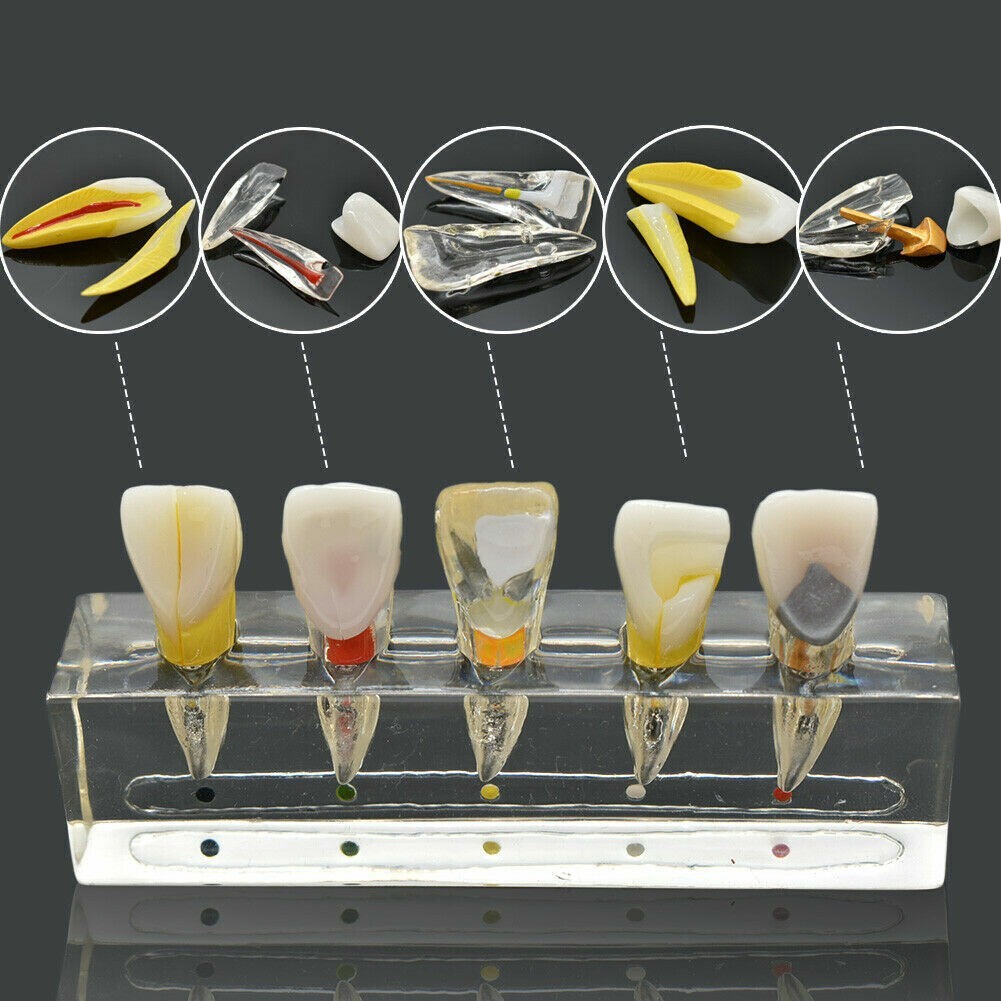 Dental Endodontic Pathology Study Model Demonstration Treatment Anterior Tooth
