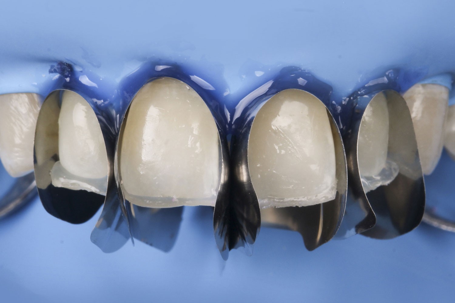 Polydentia Unica Anterior Dental Matrix System Intro Kit II Free Ship
