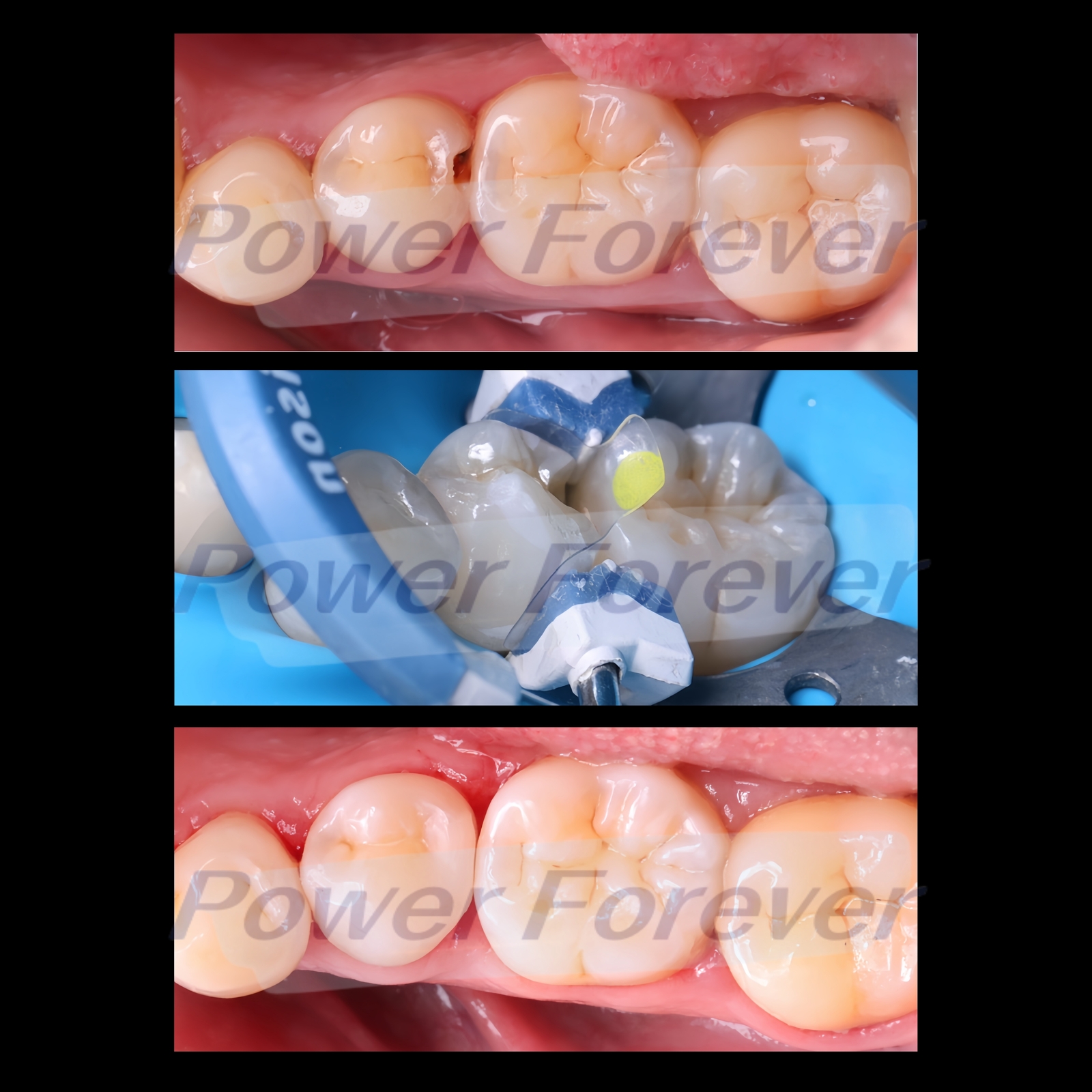 M8.0 Dental Posterior Clear Matrix Restorative BT Bow Matrices Fit BioClear