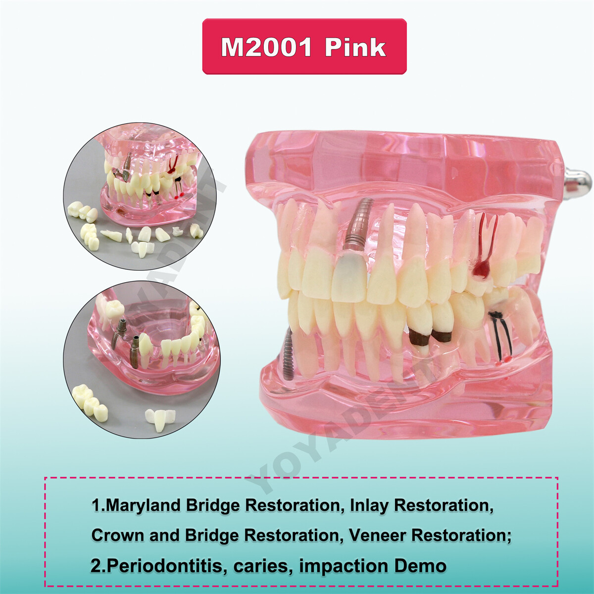 US Dental Typodont Teeth Model Ortho Overdenture Implant Practice Teaching Demo