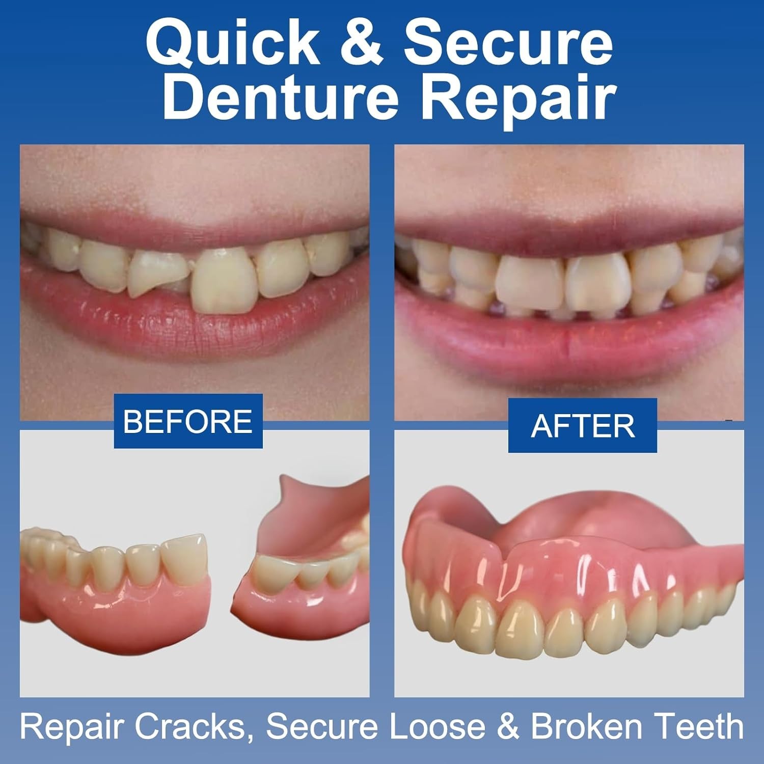 1oz, Repair Cracks & Secure Loose Teeth, Super-Strong Adhesive—Lasts Days to …