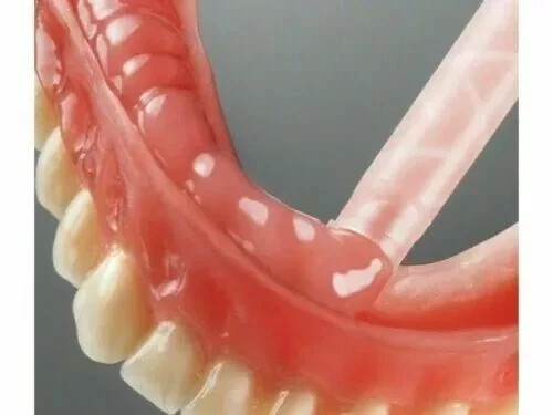 MOLLOSIL Long Term A Silicone based Denture Reline Material CHAIRSIDE USE F.S,,