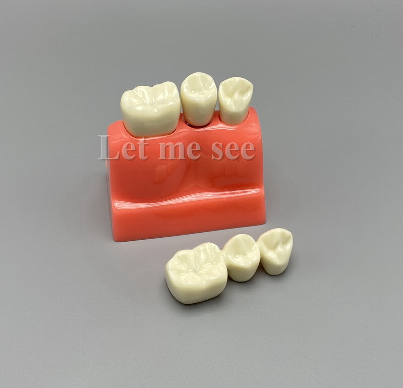 Dental Teaching Model Removable Communication Models Crown Bridge 4 Times Impant