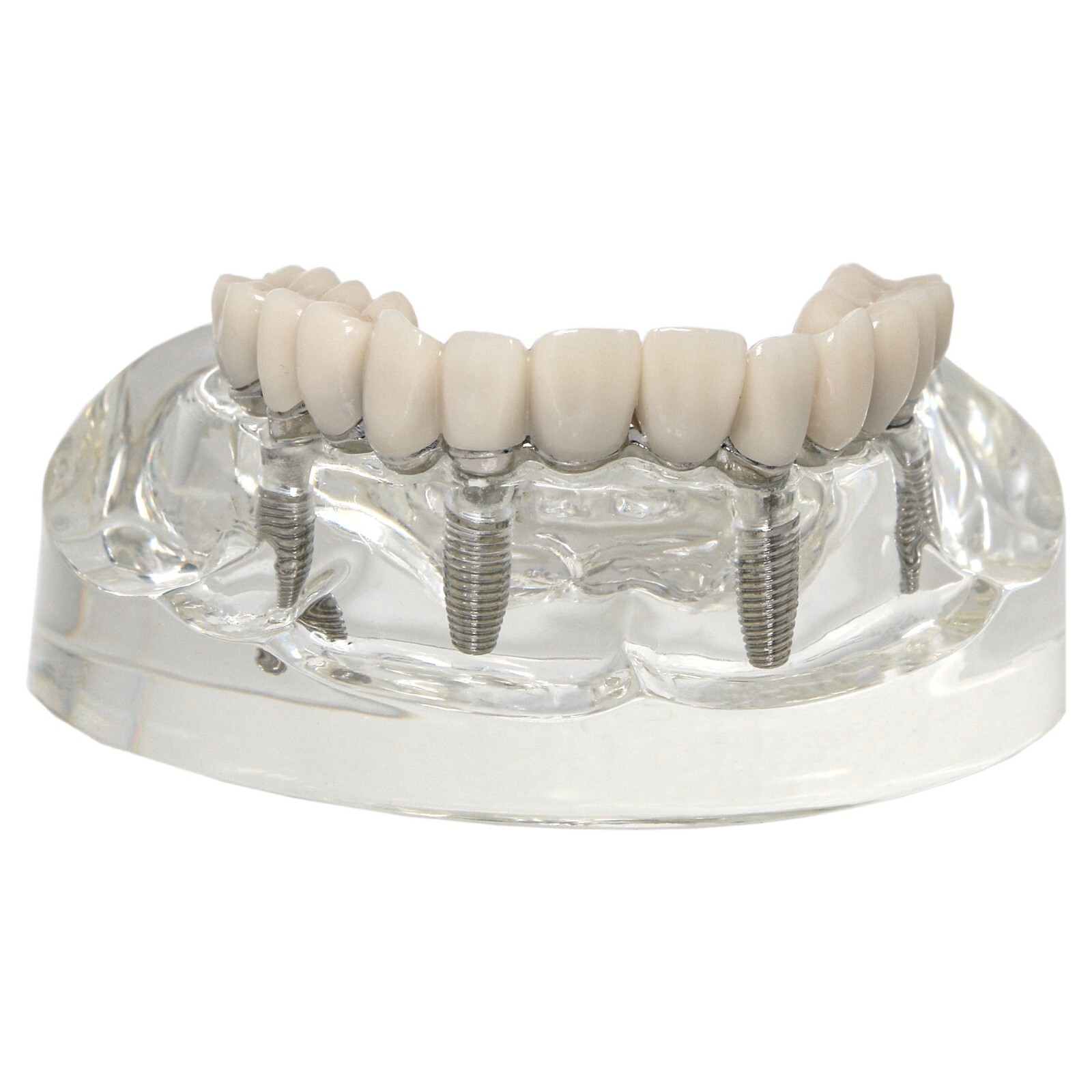 All-on-4 Overdenture Clear Model Dental Implant Upper Jaw Restoration 4 Screws