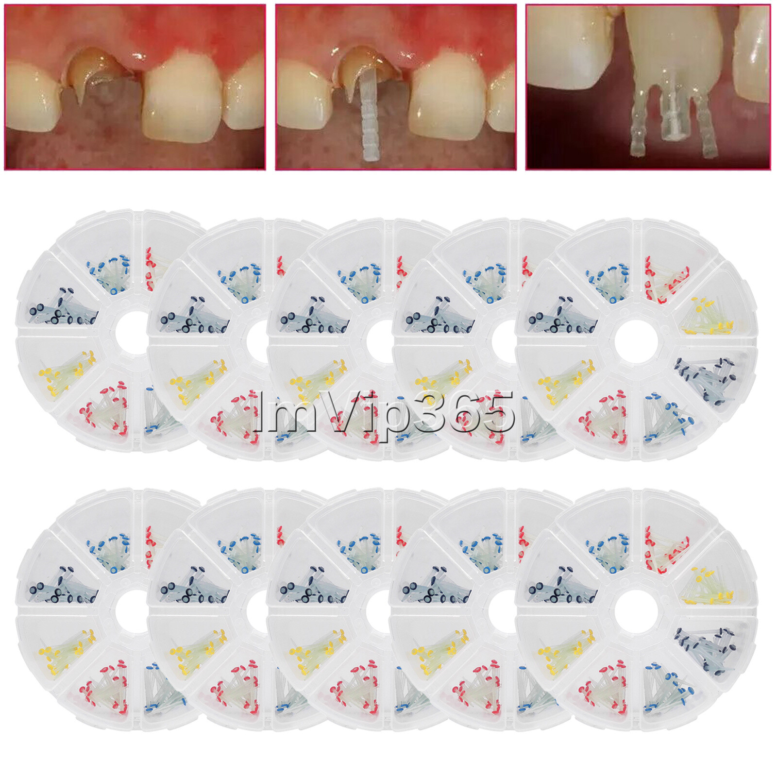 200 Pcs Dental Fiber Post Glass Quartz Teeth Restorative 1.0 1.2 1.4 1.6 1.8mm