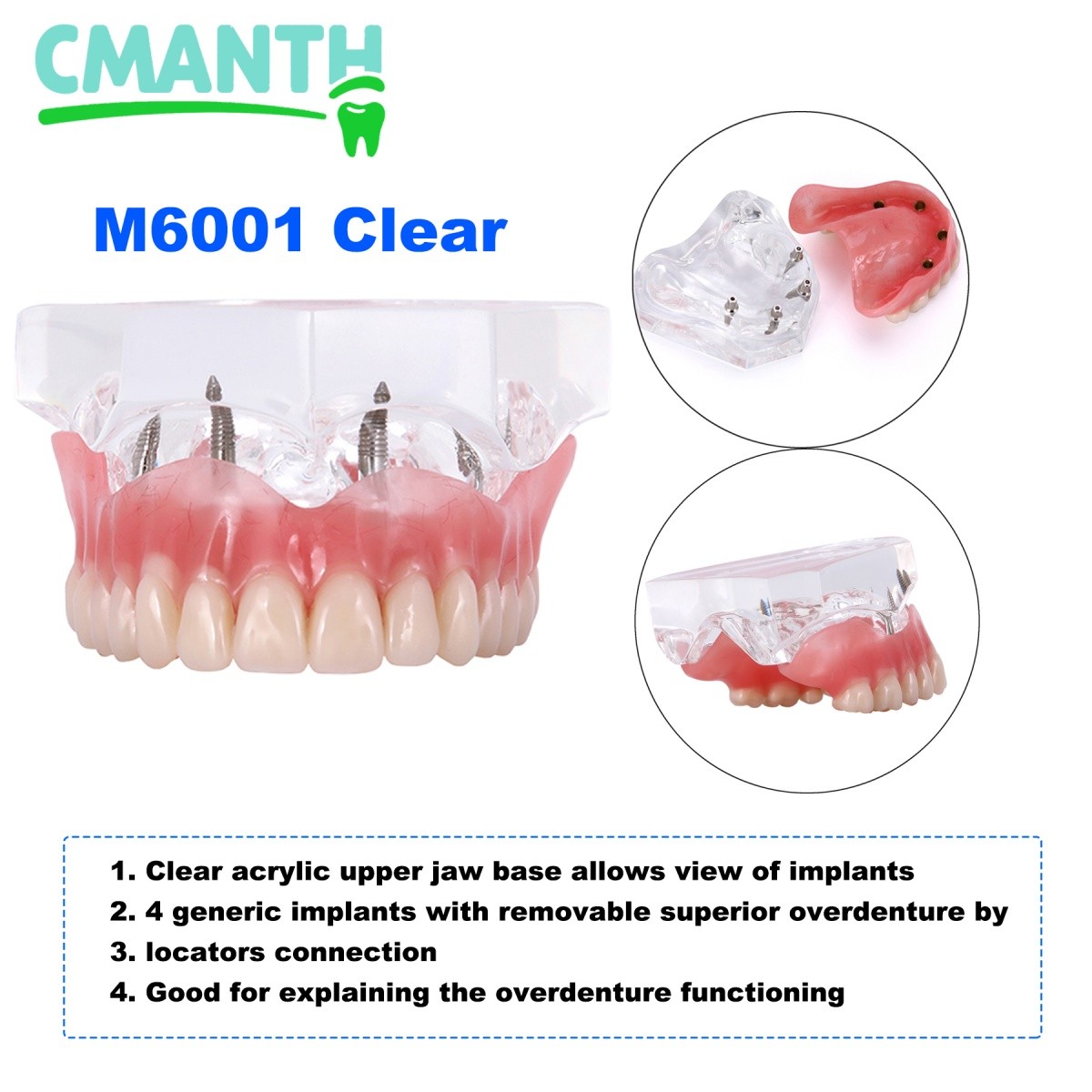 Dental Implant Teeth Model Overdenture Restoration Model 4 Implants Upper Lower