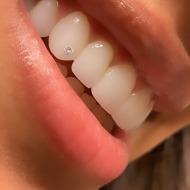 SparkleBites Professional Tooth Gem Kit. Strong tooth gem glue and tooth bonding