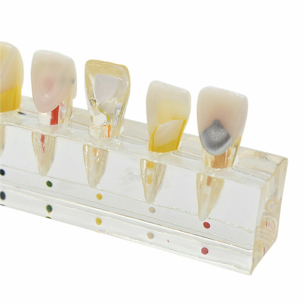 Dental Endodontic Pathology Study Model Demonstration Treatment Anterior Tooth