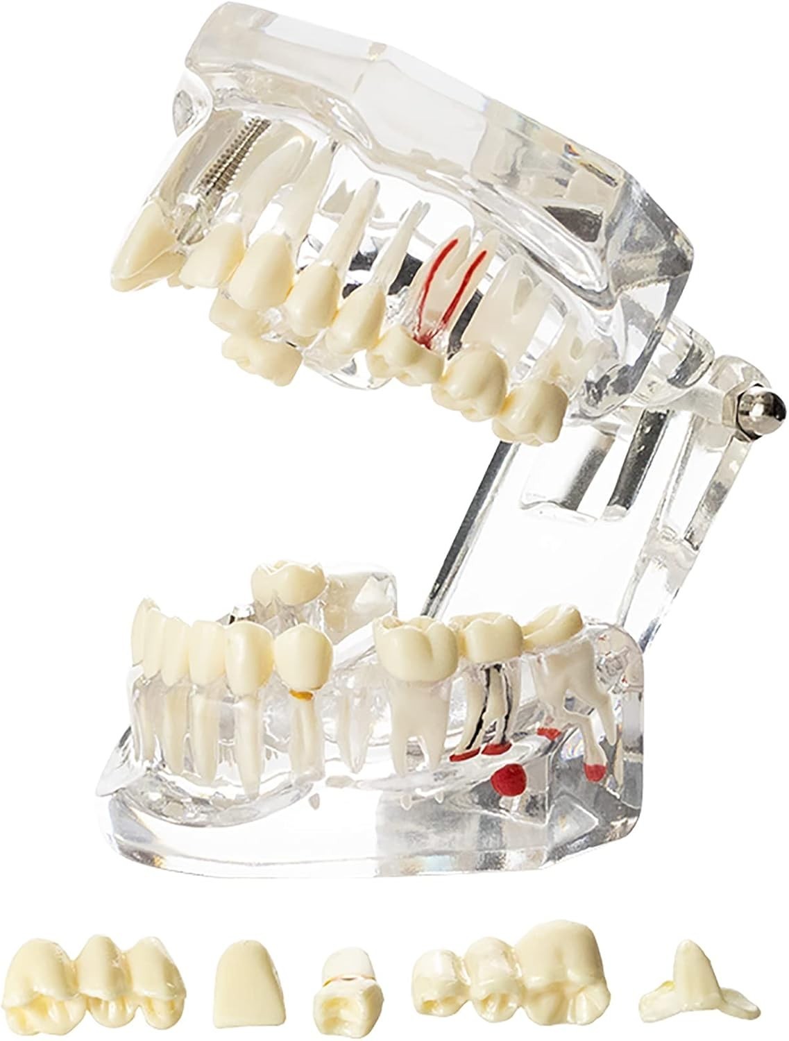 Educational Implant Typodont Model for Role Play – Perfect for Dental Schools