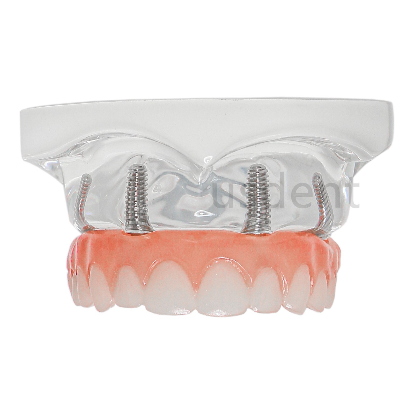 All on 4 Dental Implant Model Overdenture Upper Jaw 4 Implant Clear Detachable