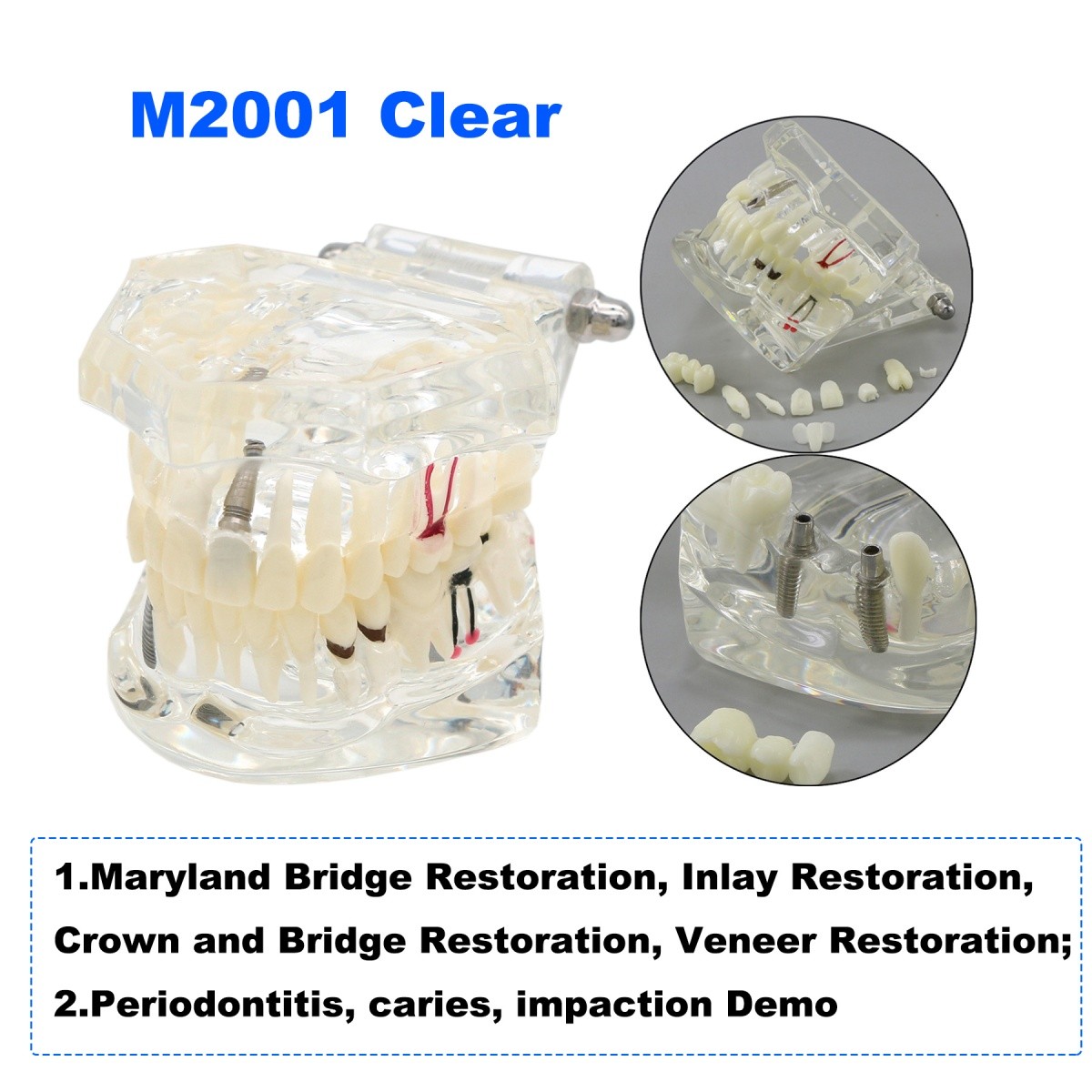 US Dental Teaching Teeth Model Implant/Perio/Disease Suture Products Demo Model