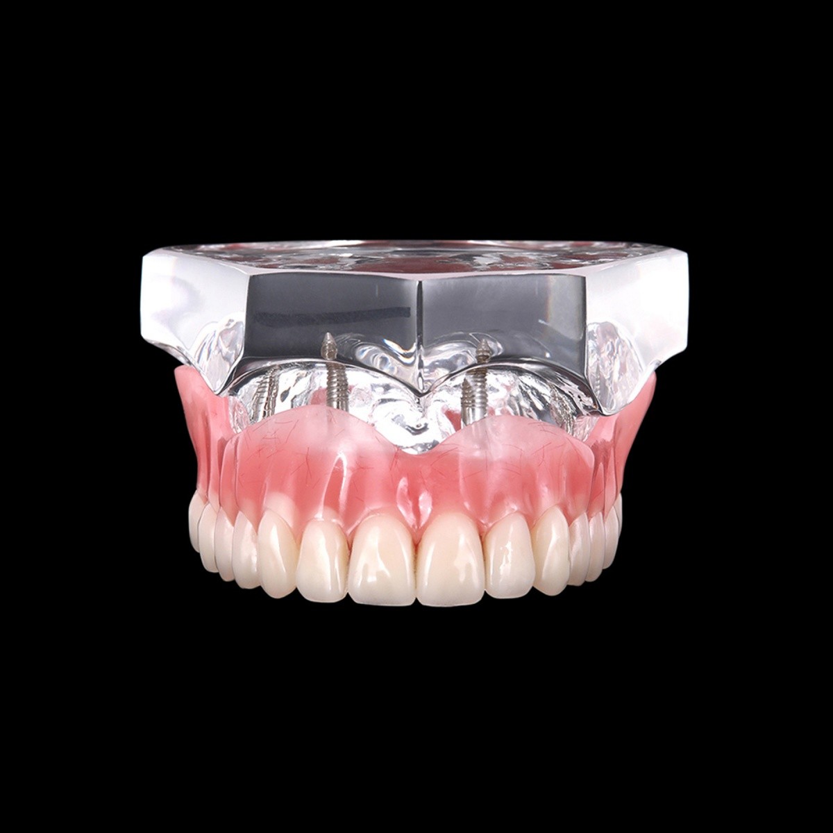 Dental Implant Teeth Model 4 Implants Upper/Lower Overdenture Restoration Model