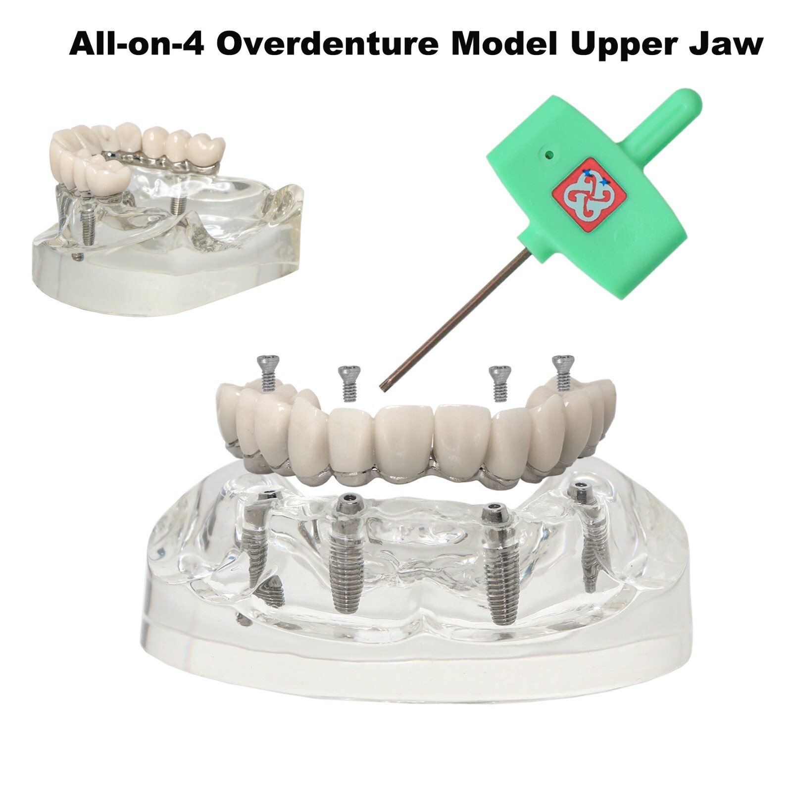 All-on-4 Overdenture Clear Model Dental Implant Upper Jaw Restoration 4 Screws