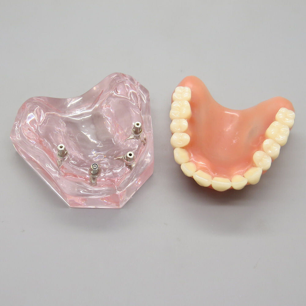 Dental High Quality Model of Upper Teeth Dentures Superior 4 Implants Maxillary
