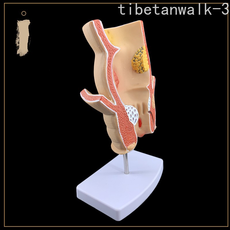 Rectal Pathology Model Intestinal Specimens Human Anatomical Model