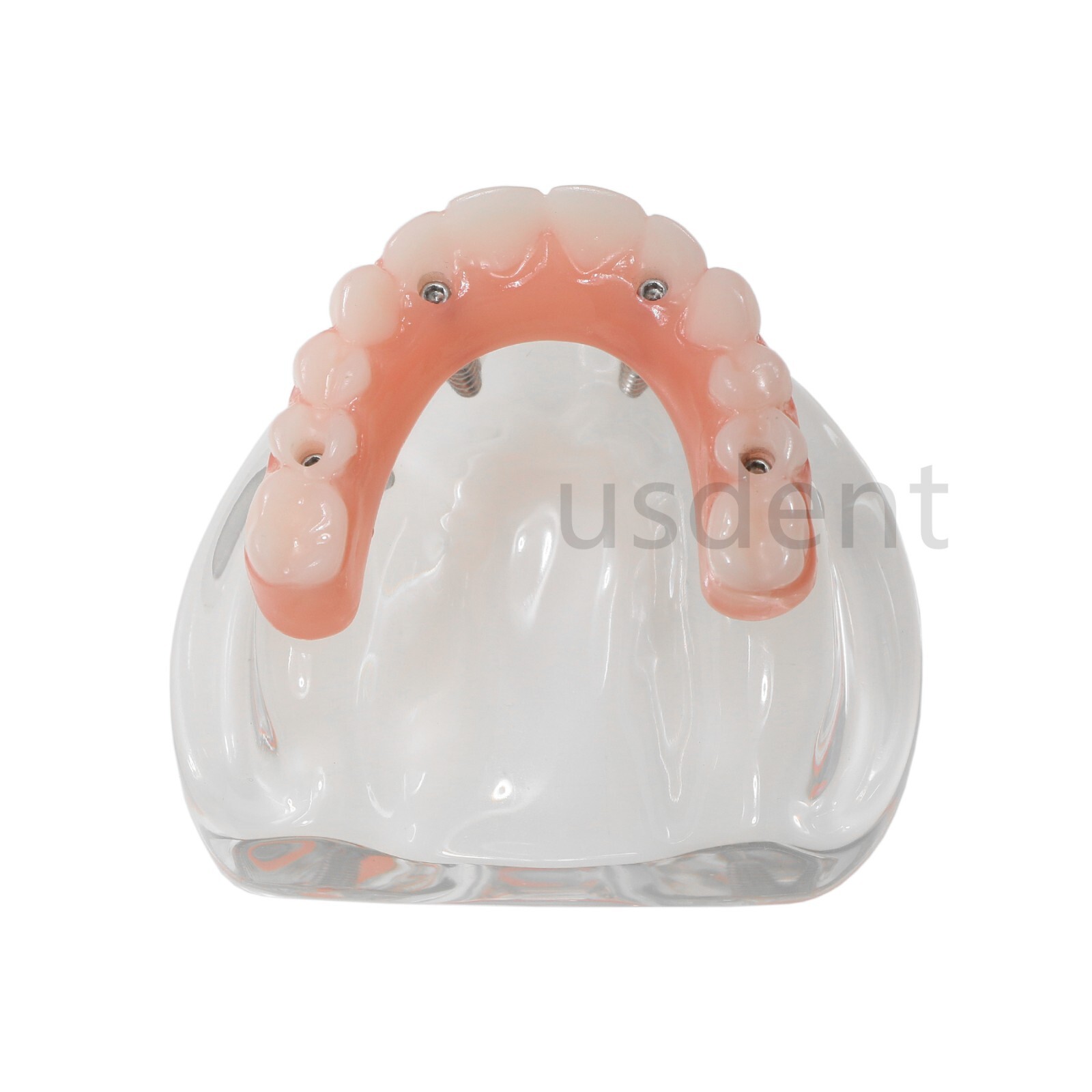 All on 4 Dental Implant Model Overdenture Upper Jaw 4 Implant Clear Detachable