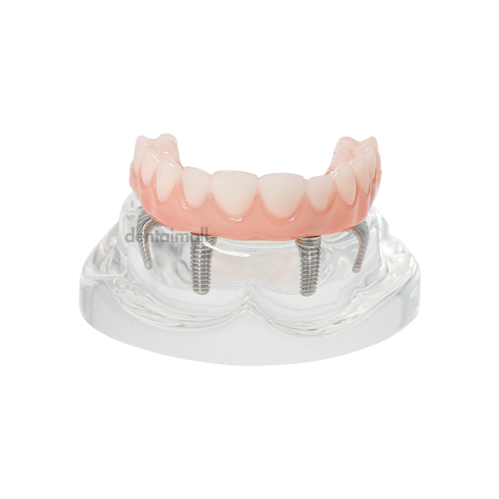 US Dental Overdenture Implant Model All-on-4 With 4 Screw Upper/Lower Clear Jaw