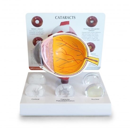 GPI Anatomical #2800 Cataract Eye Model Eyeball Pathology
