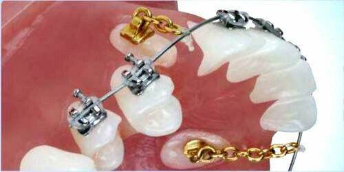 Dental Orthodontic Button Chains Lingual Chain Gold Plated 2pcs/pack Round
