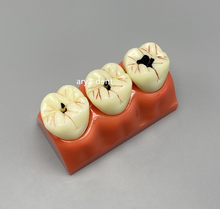 4 Times Dental Caries Teeth Detachable Abutment Dentist Study Teaching Models