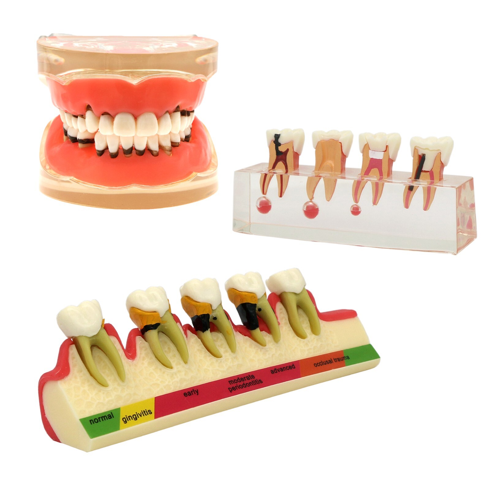 Multi Types Dental Typodont Teeth Model Implant Pathological Perio Practice Demo