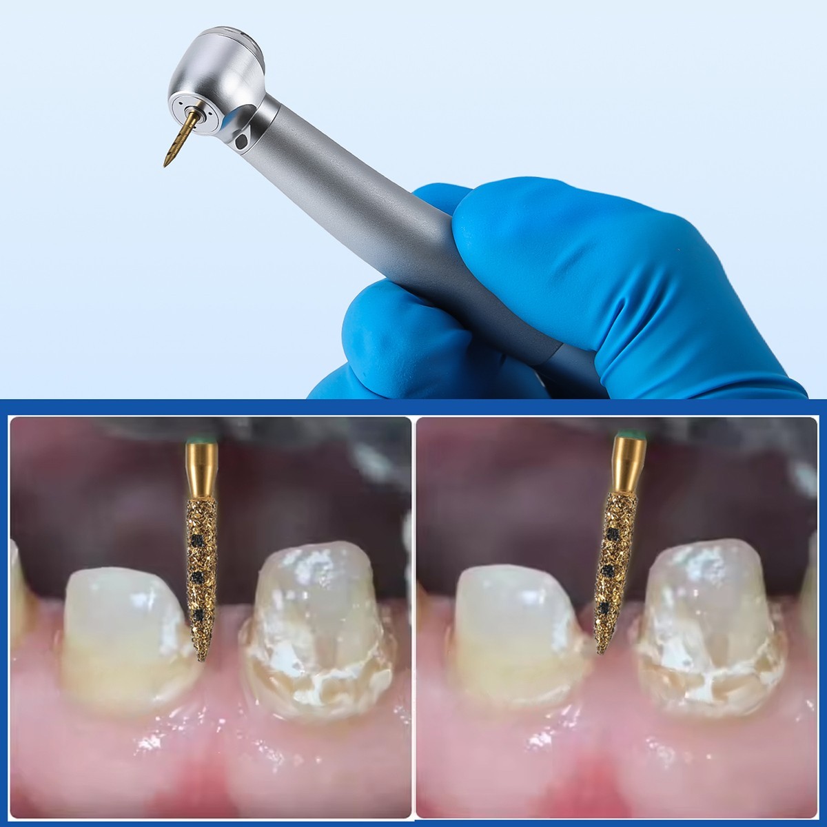 AZDENT Dental BOPT Vertical Preparation Diamond Burs FG 1.6mm Titanium Plating