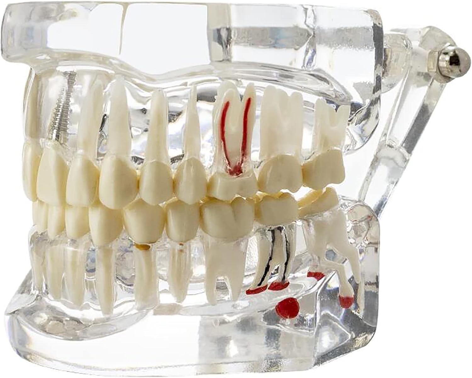 Educational Implant Typodont Model for Role Play – Perfect for Dental Schools