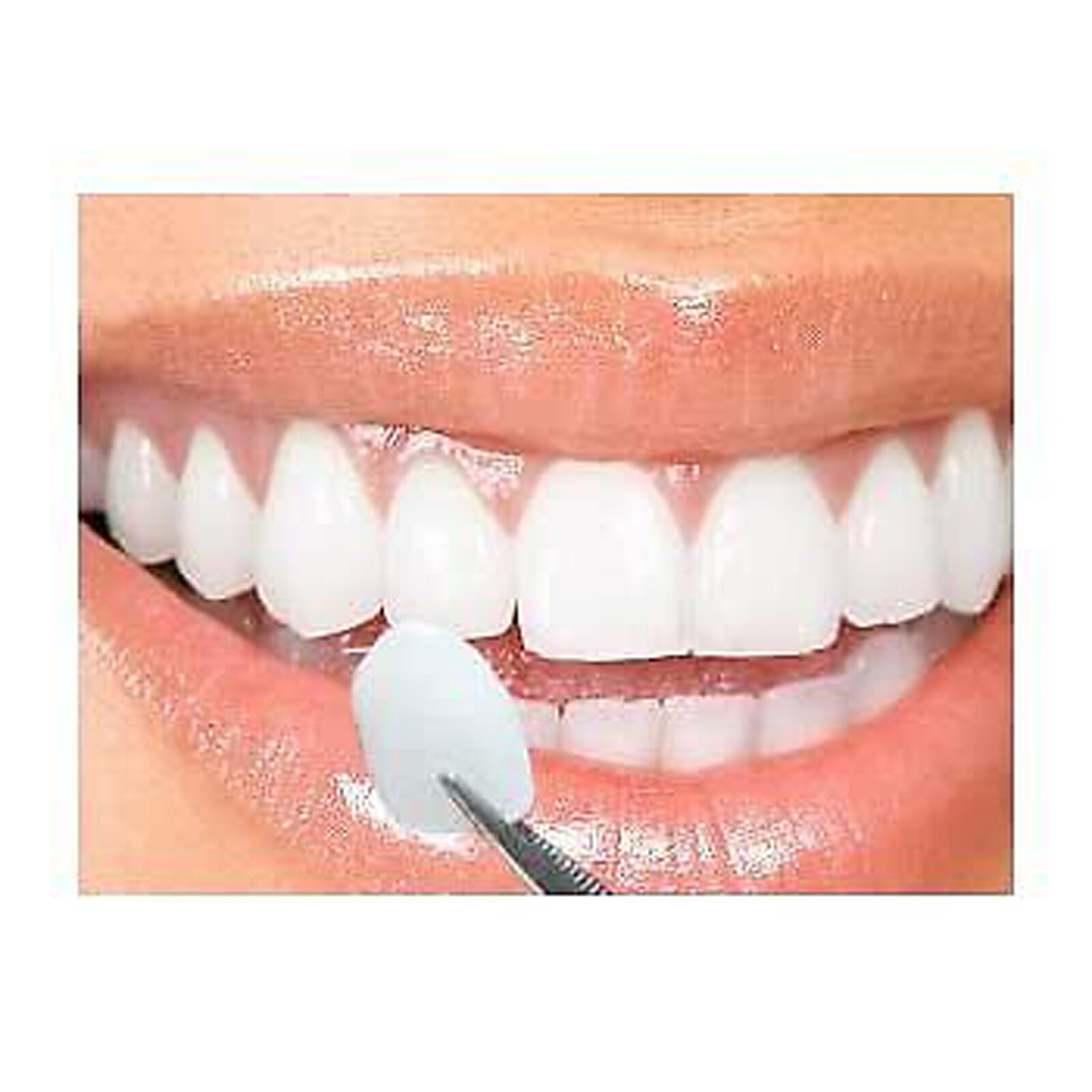 100pcs Dental Componeer Thin Whitening Resin Veneer Upper Anterior Teeth