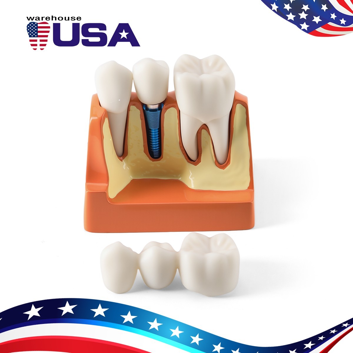 Dental 4Times Teeth Model Implant Analysis Crown Bridge Removable Study Training