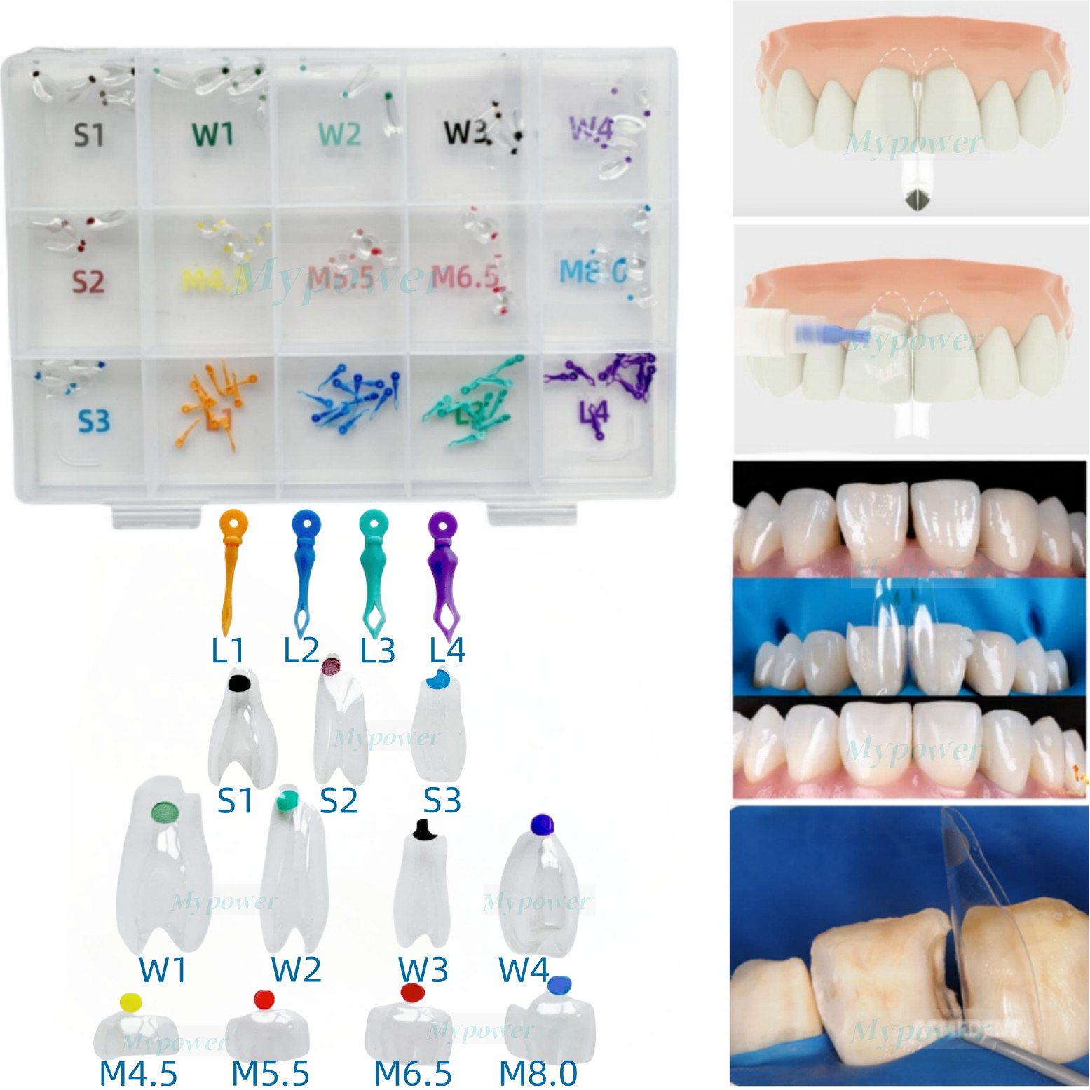 Clear Matrix Dental Diastema Matrices Wedge Similar with Bio Clear Matrice TORVM