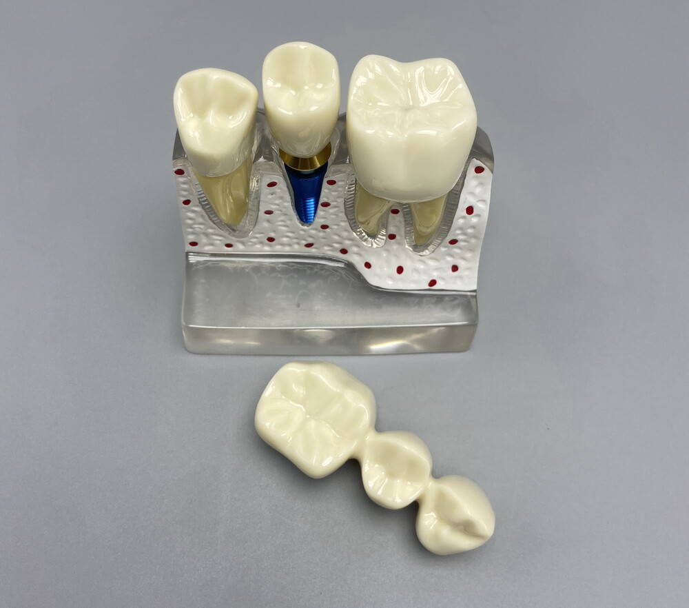 Dental Teaching Model Removable Communication Models Crown Bridge 4 Times Impant