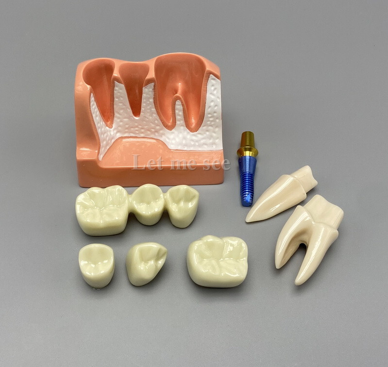 Dental Teaching Model Removable Communication Models Crown Bridge 4 Times Impant