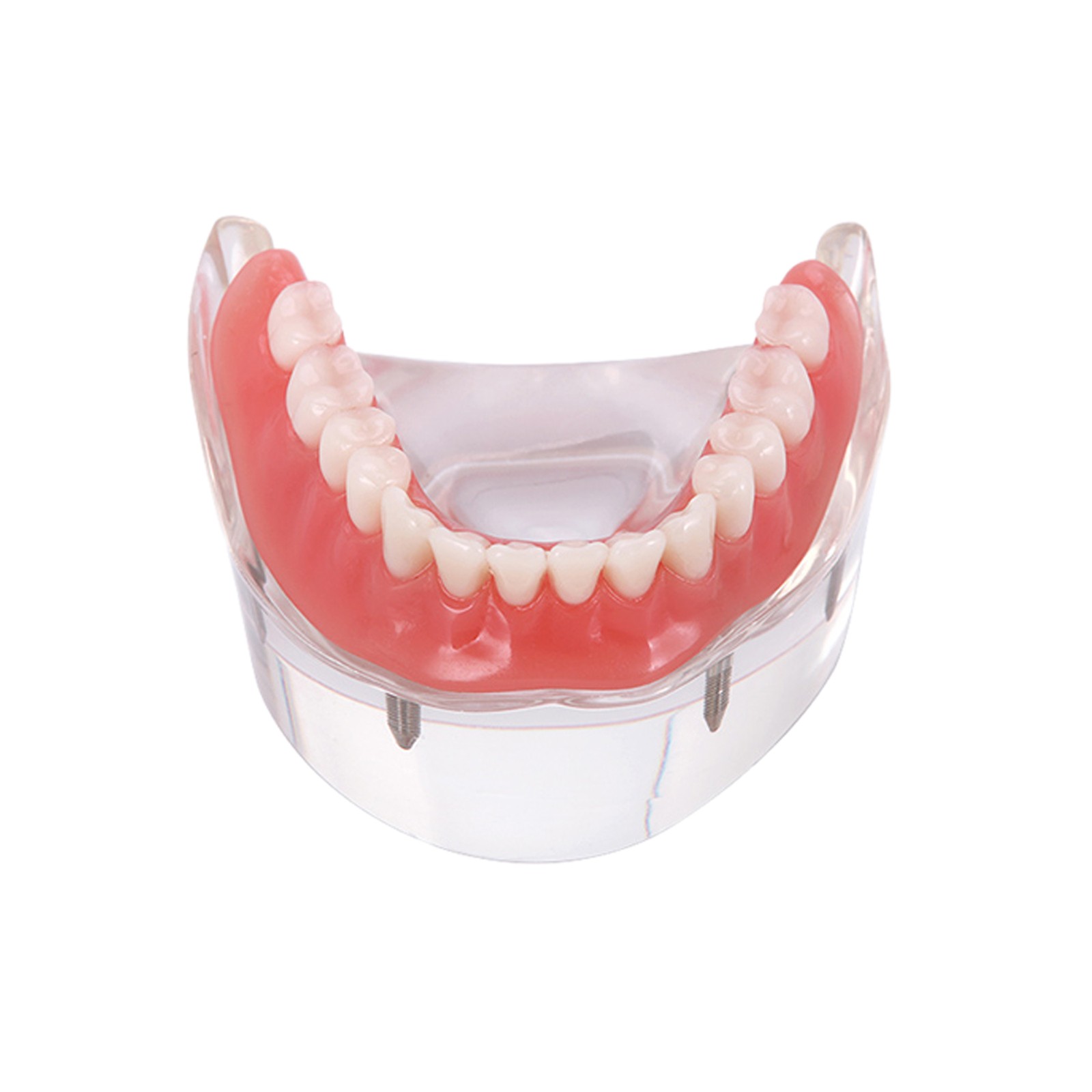 Dental Teeth Model Upper Lower Tooth 4 Implants Restoration Overdenture Model