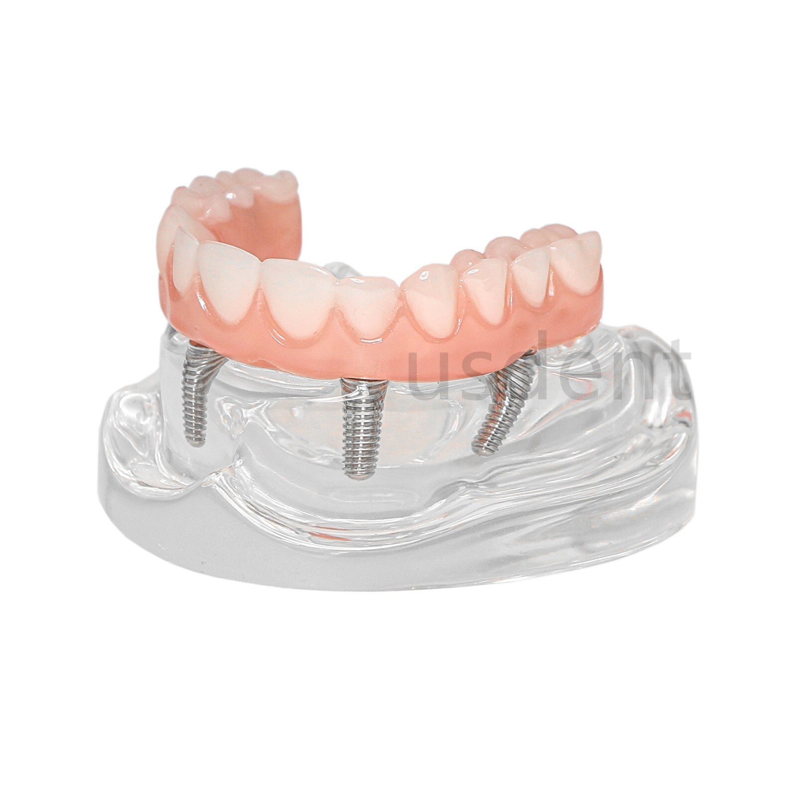 All on 4 Dental Implant Model Overdenture Upper Jaw 4 Implant Clear Detachable