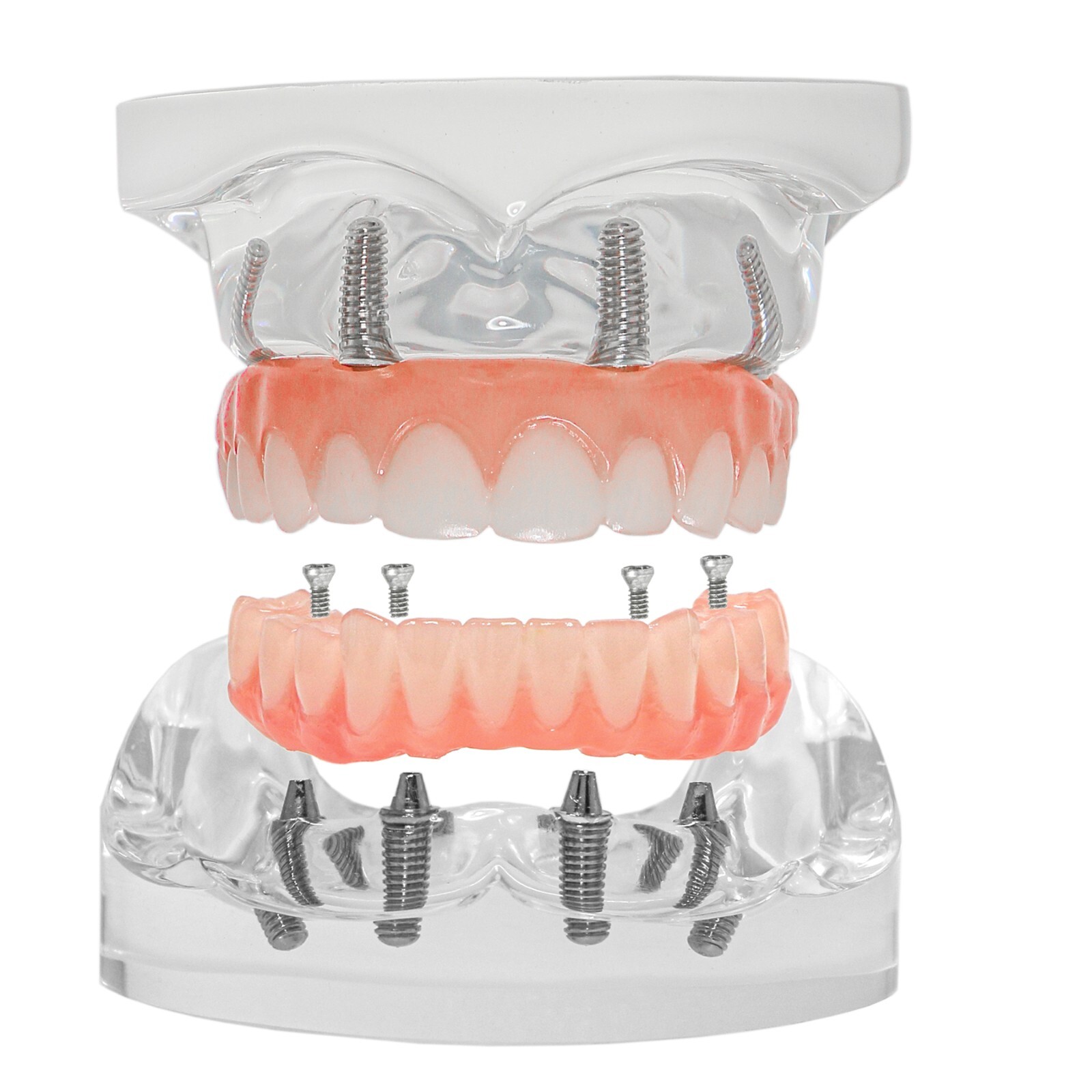 Demo Overdenture All On 4/All On 6 Treatment Dental Implant Model 4/6 Screws Lab